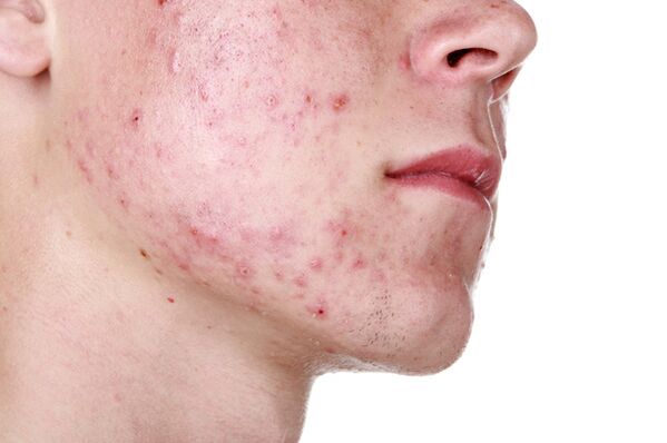Kožné lézie na tvári s demodikózou